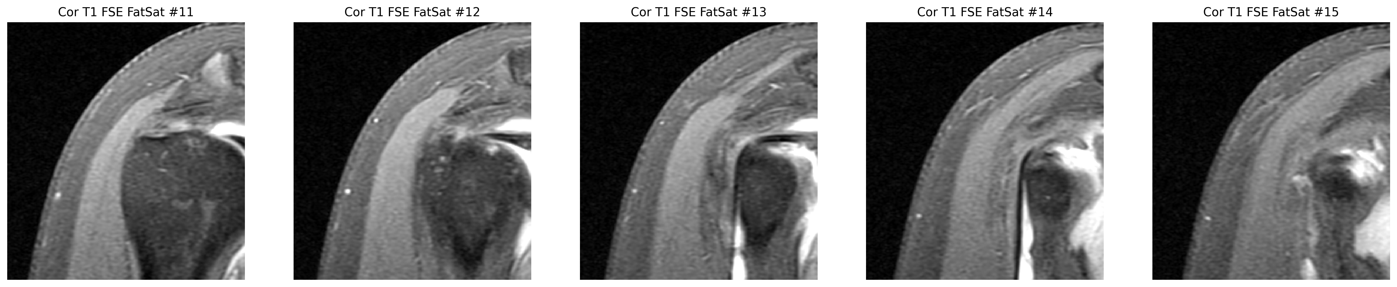 Coronal MRI slices focused on the supraspinatus tendon footprint.